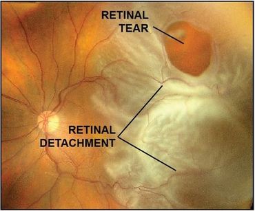 Retinal Tear vs. Retinal Detachment - Monterey, CA - Salinas